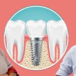 डेंटल इंप्लांट ही कृत्रिम दांत लगवाने का सबसे बेहतर विकल्प : डॉ मनीष गौतम